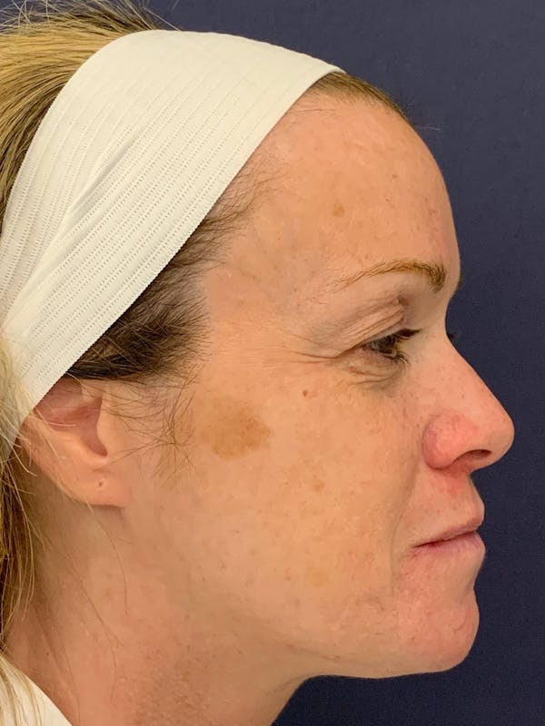 Blepharoplasty (Eyelid Surgery) Before & After Gallery - Patient 4447876 - Image 5