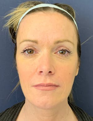 Blepharoplasty Before and After results
