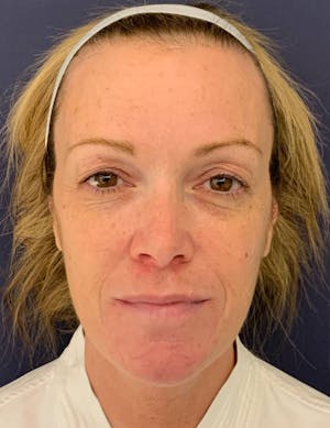 Blepharoplasty Before and After results