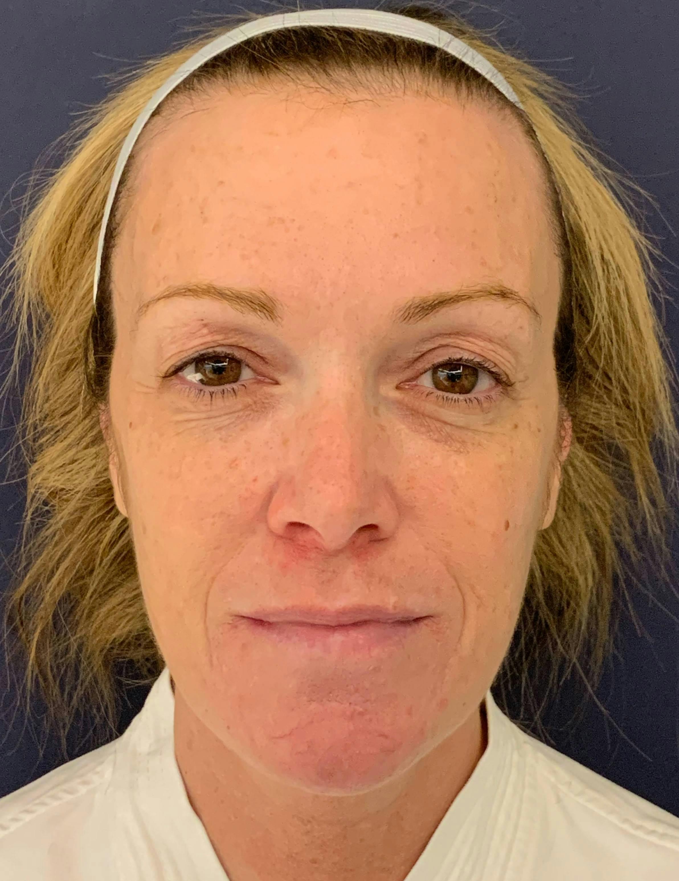 Blepharoplasty (Eyelid Surgery) Before & After Gallery - Patient 4447876 - Image 1