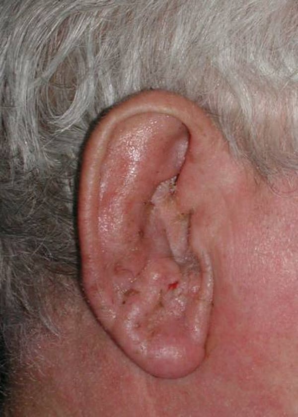 Ear Repair Before & After Gallery - Patient 4448187 - Image 2