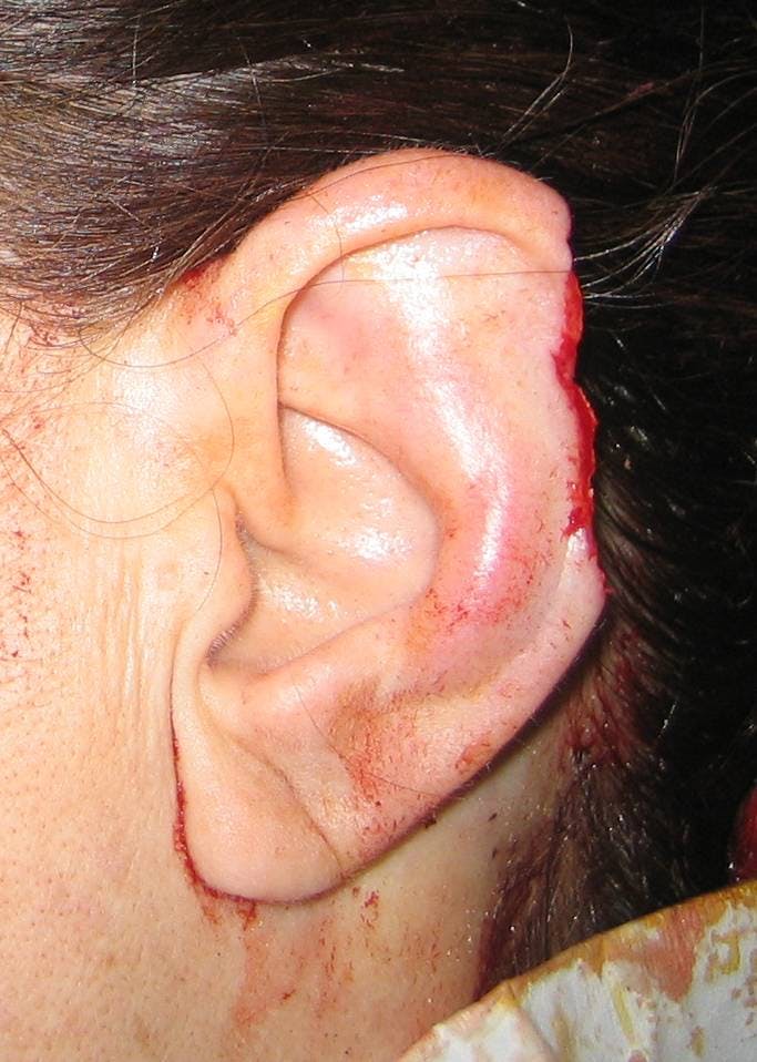 Ear Repair Before & After Gallery - Patient 4448225 - Image 1