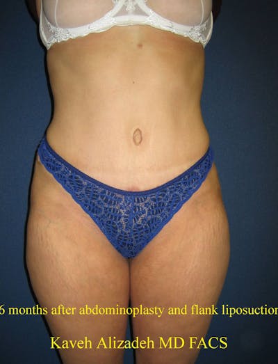 Tummy Tuck (Abdominoplasty) Gallery - Patient 4448730 - Image 2