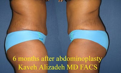 Tummy Tuck (Abdominoplasty) Before & After Gallery - Patient 4448769 - Image 4