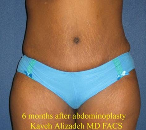 Tummy Tuck (Abdominoplasty) Before & After Gallery - Patient 4448769 - Image 2