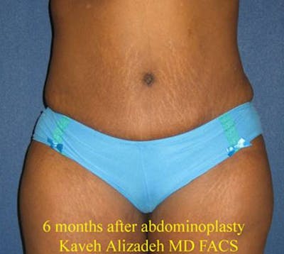 Tummy Tuck (Abdominoplasty) Gallery - Patient 4448769 - Image 2