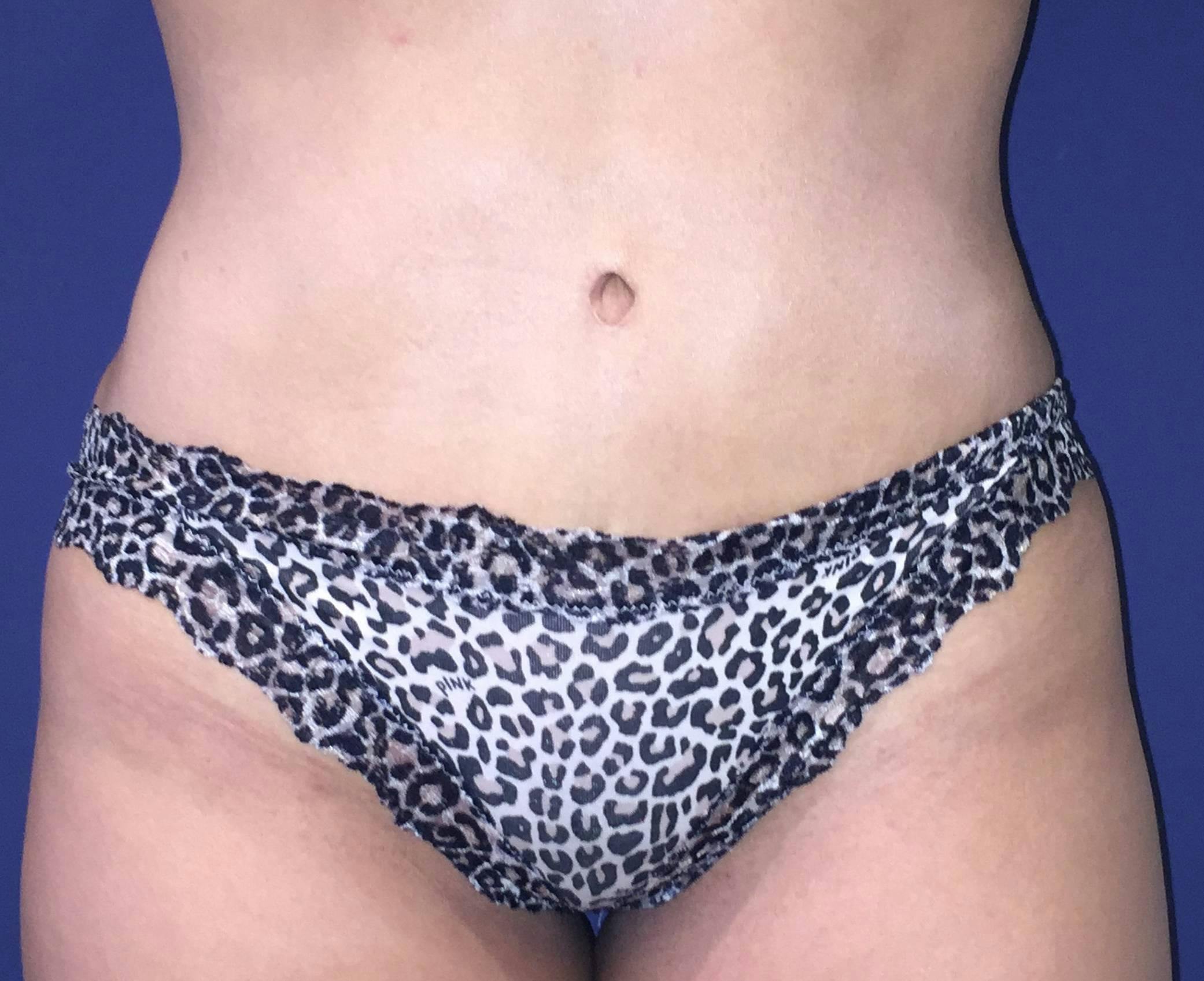 Liposuction Gallery - Patient 4452356 - Image 2