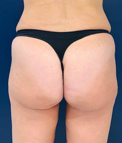 Brazilian Buttock Augmentation Before & After Gallery - Patient 4452425 - Image 2