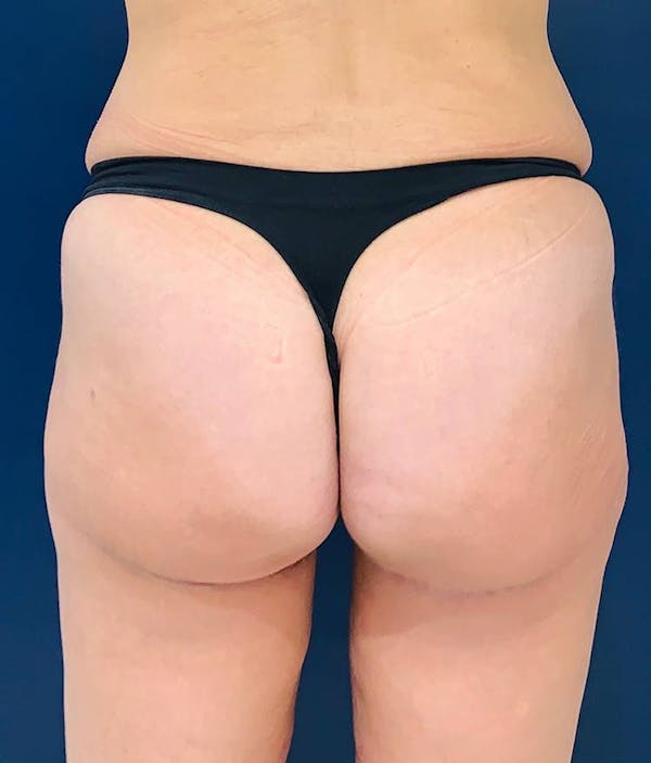 Brazilian Buttock Augmentation Before & After Gallery - Patient 4452425 - Image 2