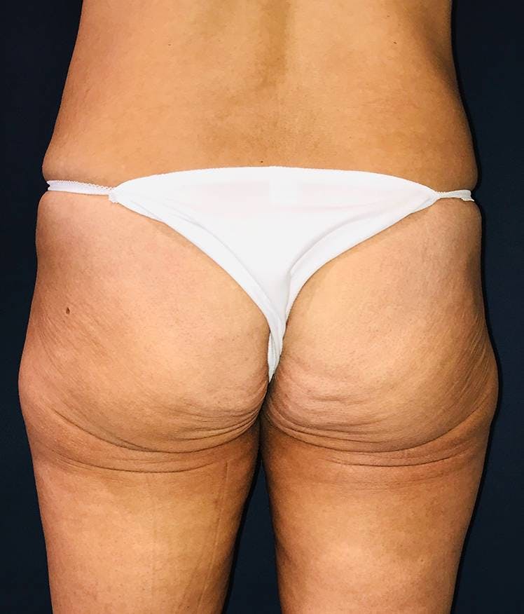 NaturaCurve® - Brazilian Buttock Augmentation Before & After Gallery - Patient 4452425 - Image 1
