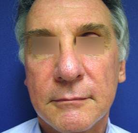 Sculptra™ Before & After Gallery - Patient 4452785 - Image 1