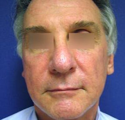 Sculptra™ Before & After Gallery - Patient 4452785 - Image 1