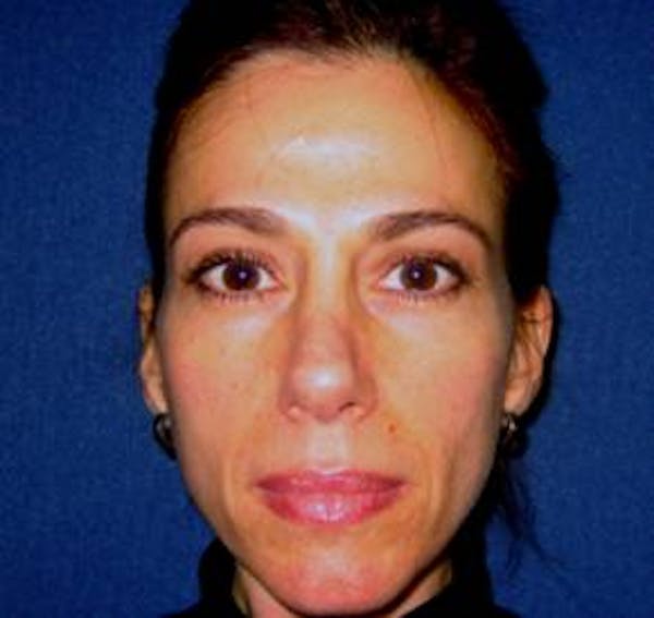 Sculptra™ Before & After Gallery - Patient 4452786 - Image 1
