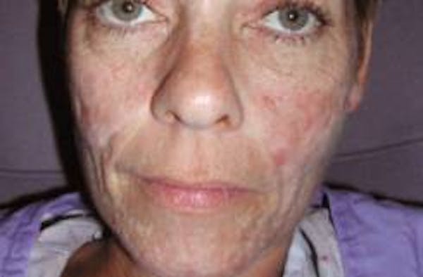 Scar Treatment Before & After Gallery - Patient 4452882 - Image 1