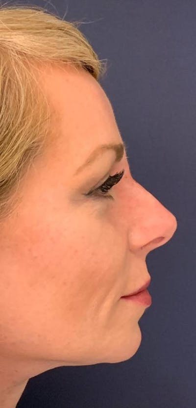 Dermal Fillers Before & After Gallery - Patient 4453298 - Image 4