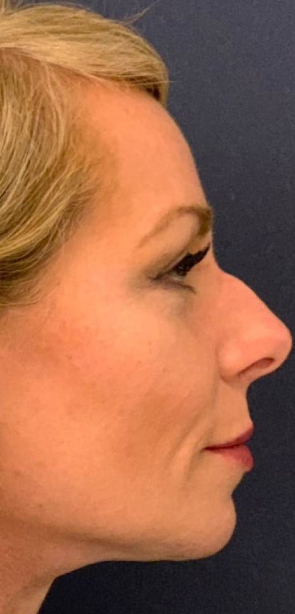 Dermal Fillers Before & After Gallery - Patient 4453298 - Image 3