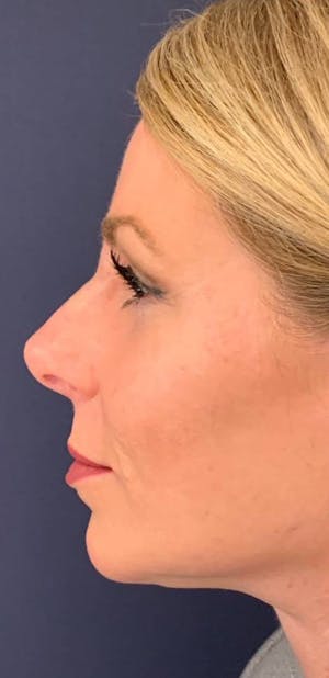 Before and After Dermal Fillers in Long Island