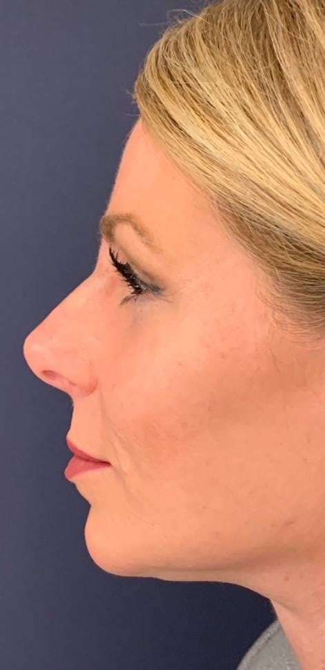Dermal Fillers Before & After Gallery - Patient 4453298 - Image 2