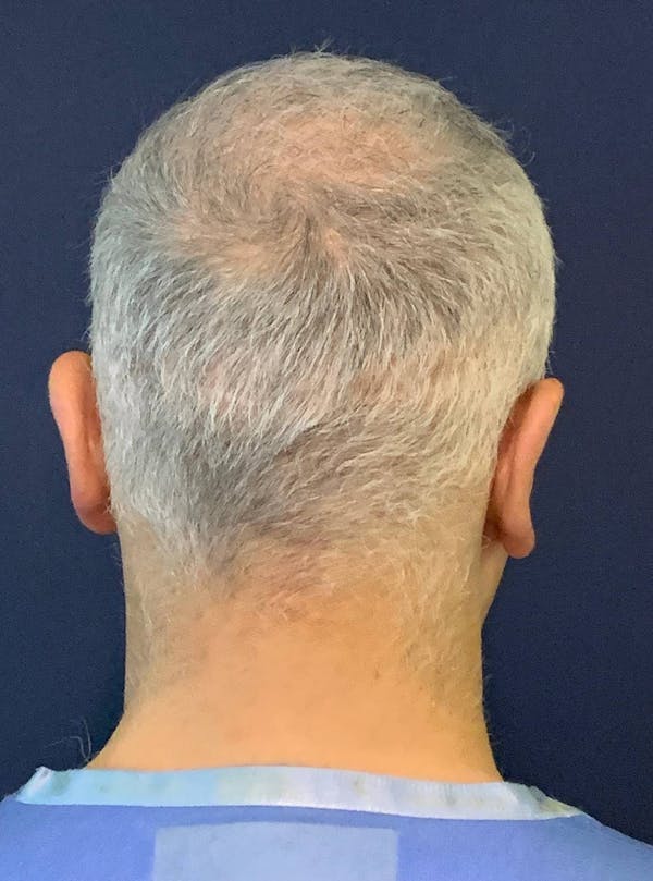 PRP/PRF for Hair Restoration Before & After Gallery - Patient 4453635 - Image 8