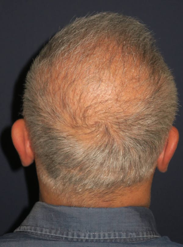 PRF/Platinum PRP 2.0 for Hair Restoration Before & After Gallery - Patient 4453635 - Image 7