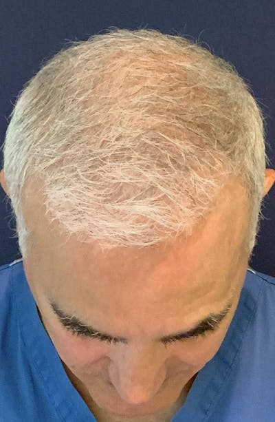 PRF for Hair Restoration Before & After Gallery - Patient 4453635 - Image 6