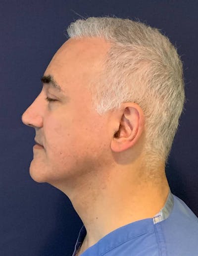 PRP/PRF for Hair Restoration Before & After Gallery - Patient 4453635 - Image 4