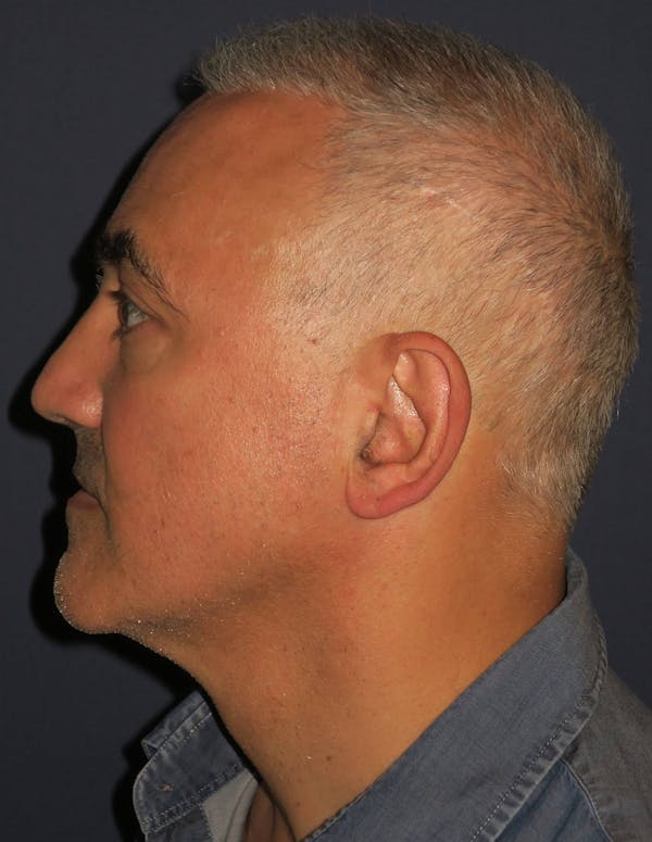 PRF/Platinum PRP 2.0 for Hair Restoration Before & After Gallery - Patient 4453635 - Image 3