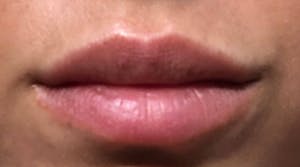 Lip Augmentation