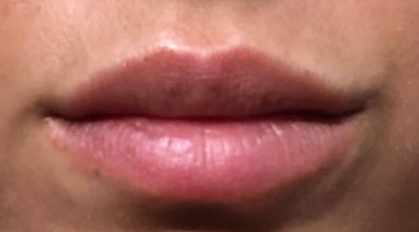 Lip Augmentation Before & After Gallery - Patient 4454372 - Image 2