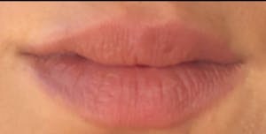 Lip Augmentation