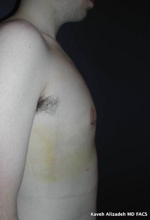 Gynecomastia