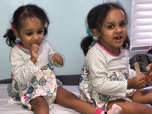 Dr. Alizadeh's patients - 3 year old twins after surgical separation.