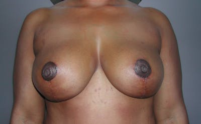 Breast Reduction Before & After Gallery - Patient 4488193 - Image 2