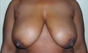 Breast Reduction