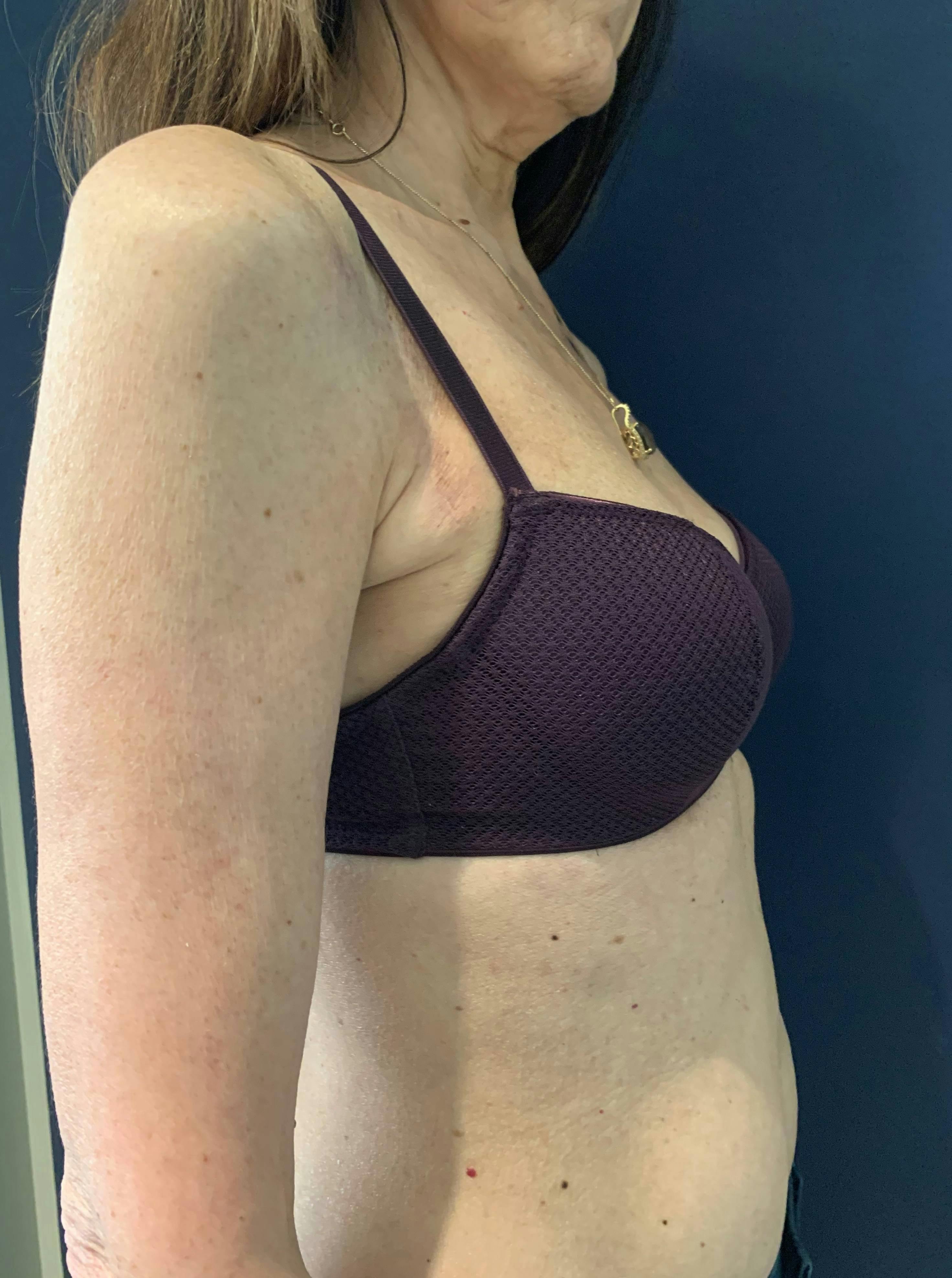Breast Reconstruction Gallery - Patient 51843252 - Image 2