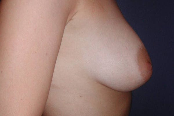 NaturaBra® Mastopexy Before & After Gallery - Patient 4488496 - Image 3