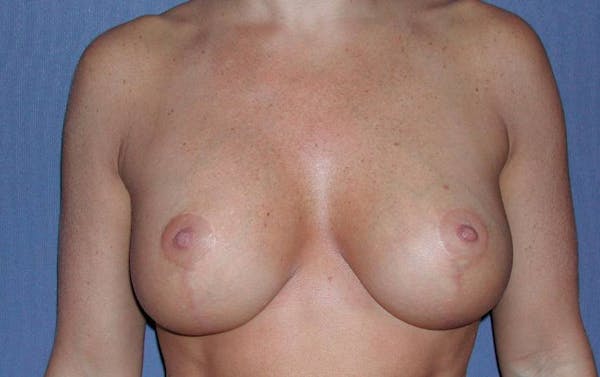 NYC Breast Lift - After Photo 02