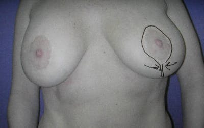 NYC Breast Lift - Before Photo 02