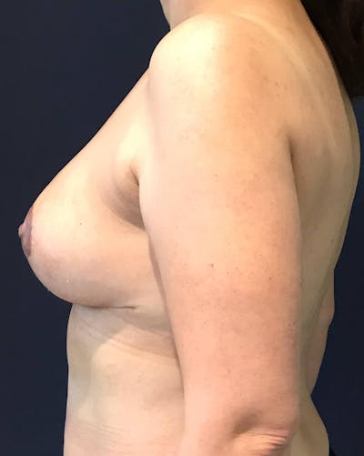 Breast Revision Before & After Gallery - Patient 4488538 - Image 4