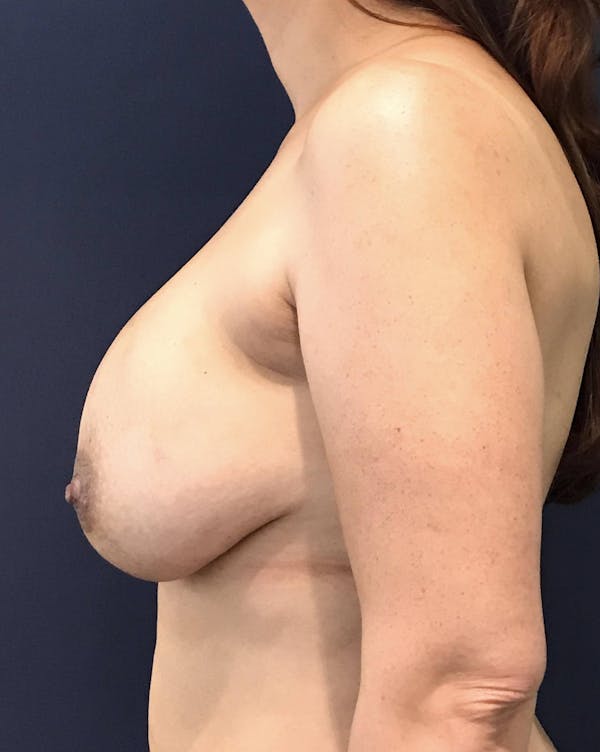 Breast Revision Before & After Gallery - Patient 4488538 - Image 3