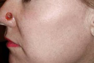 Skin Cancer Treatment