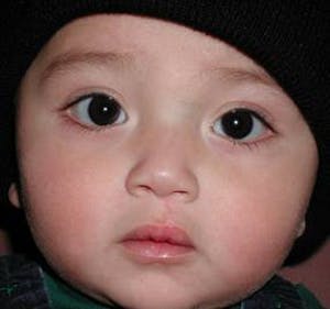 Pediatric Plastic Surgery