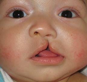 Cleft lip and nose repair Before & After Gallery - Patient 4488589 - Image 1