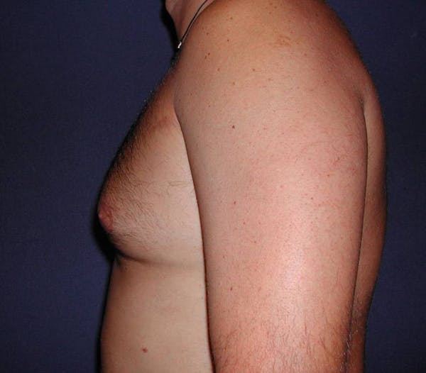 Gynecomastia (Male Breast Reduction) Gallery - Patient 4454711 - Image 3