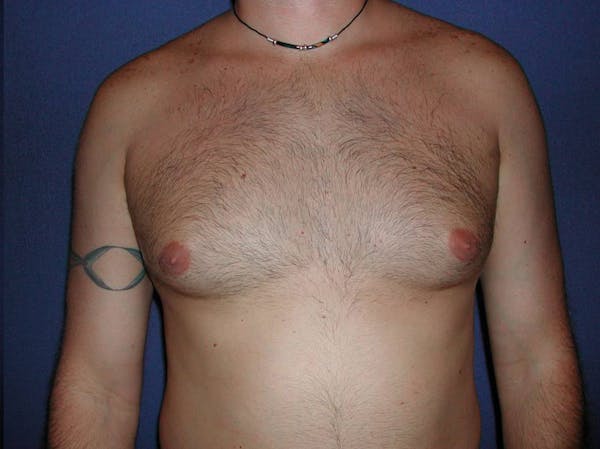 Gynecomastia (Male Breast Reduction) Before & After Gallery - Patient 4454711 - Image 1