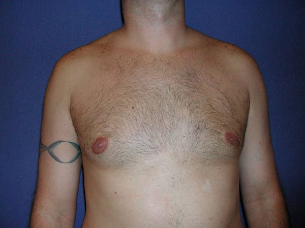 Gynecomastia (Male Breast Reduction) Before & After Gallery - Patient 4454711 - Image 2