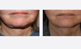 Before and after of a patient's chin from Sciton Halo treatment.