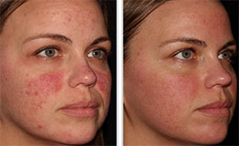 Before and after of a patient's face from Sciton Halo treatment.