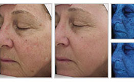 Before and after of a patient's cheeks and face from Sciton Halo treatment.