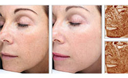 Before and after of a woman's face from Sciton Halo treatment.